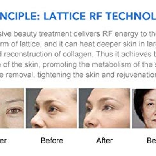 Portable RF fractional Machine face Tightening rejuvenate