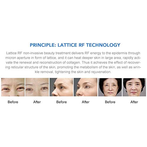 Portable RF fractional Machine face Tightening rejuvenate