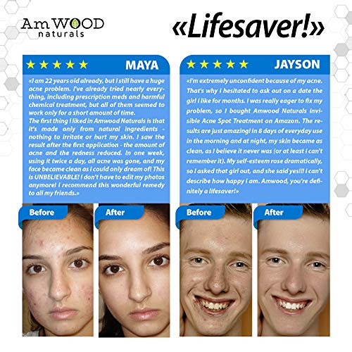 Acne Spot Treatment Cream - Made in USA - Fast-Acting Formula for...