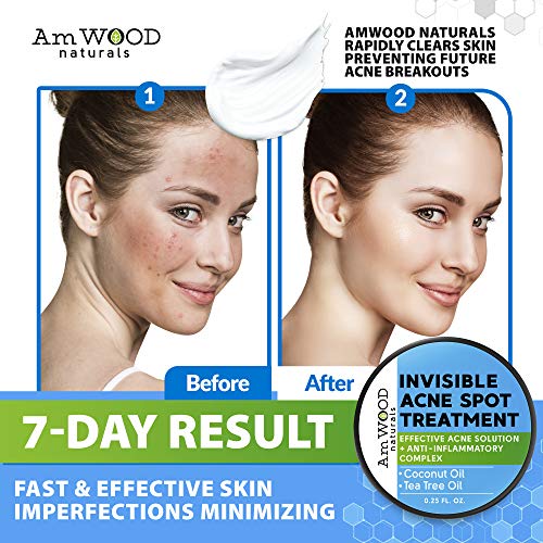 Acne Spot Treatment Cream - Made in USA - Fast-Acting Formula for...