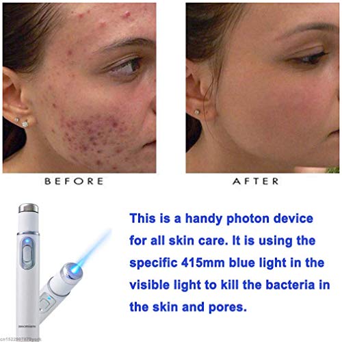 New Blue Light Therapy Varicose Veins Pen - Soft Scar Wrinkle Rem...