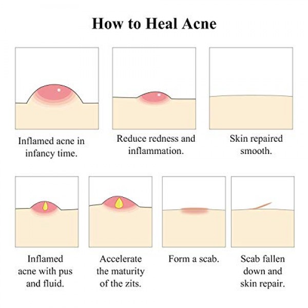 Acne Treatment Serum, BREYLEE Tea Tree Clear Skin Serum for Clear...
