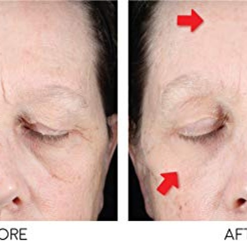 Bratoxinsta Instant Anti-Wrinkle Skin Lifting Botox Serum Saggy S...
