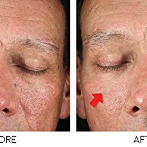 Bratoxinsta Instant Anti-Wrinkle Skin Lifting Botox Serum Saggy S...
