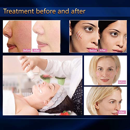 cenoz Portable High Frequency Wand,Handheld High Frequency Facial...