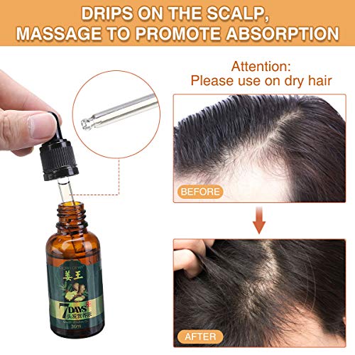 CHARMINER Ginger Germinal Oil, 3 PCS Ginger Hair Growth Oil, Gi...
