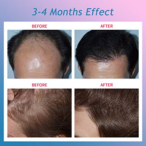 CNV Hair Regrowth For Men & Women Device,Permanent Hair Growth He...