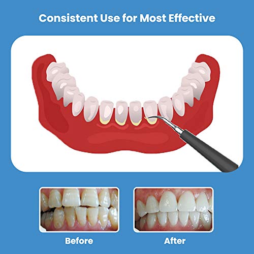 Electric Dental Tartar Calculus Plaque Remover with Mouth Mirror ...