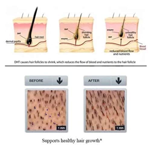 Hair ReGrowth Serum - Hair Restore Biotin Serum Organic Essential...