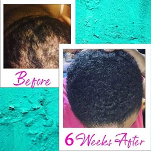 Hair ReGrowth Serum - Hair Restore Biotin Serum Organic Essential...