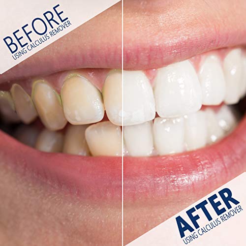 Plaque Remover For Teeth Cleaning Kit - Gum Stimulator - Dental C...