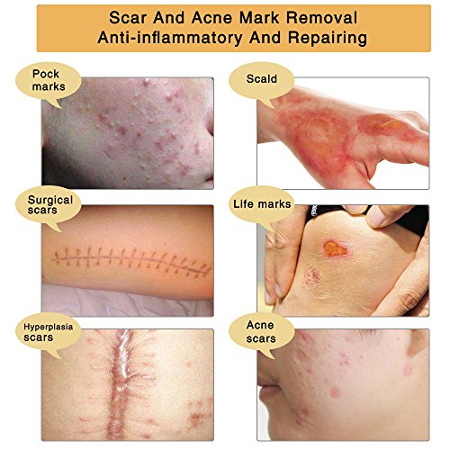 Scar Removal Cream For New and Old Scars,Stretch Mark Removal Gel...