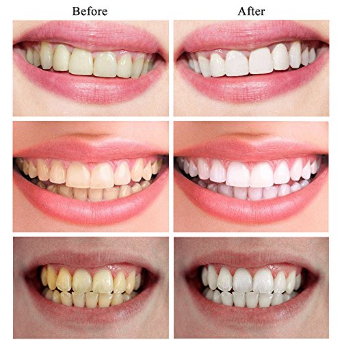 Teeth Whitening Kit with Led Light for Sensitive Teeth, 35% Carba...
