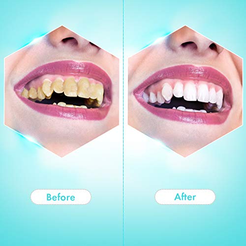 Teeth Calculus Remover, Dental Tools, Electric Tartar Scraper Pla...