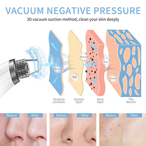 Blackhead Remover Pore Vacuum - Kahe Facial Pore Cleaner Electric...