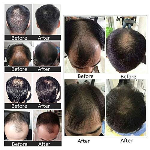 Ginger Germinal Oil Hair Growth Serum 2PCS + Bonus Hair Comb | Gi...