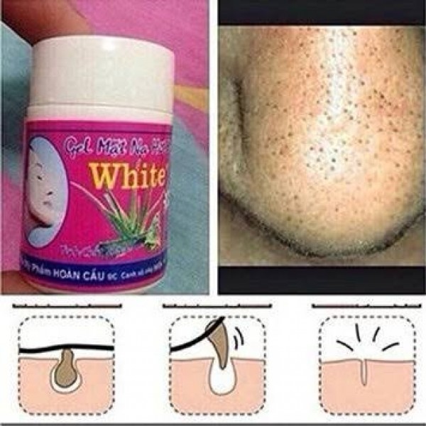 3 Set X Blackhead Whitehead Pimples Pore Acne Cream Vietnam Mask ...