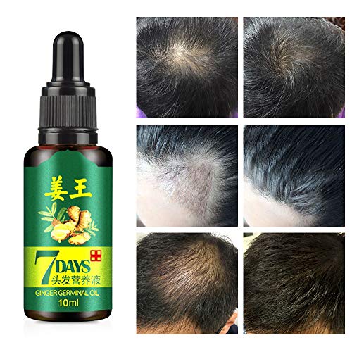 Ownest 3 Packs Hair Growth Ginger Essence Oil,Hair Loss and Hair ...