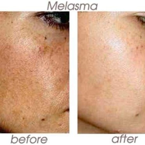 Planet Eden 70% Glycolic Acid Skin Chemical Peel Kit with Treatme...