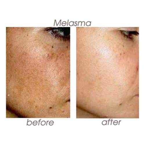 Planet Eden 70% Glycolic Acid Skin Chemical Peel Kit with Treatme...
