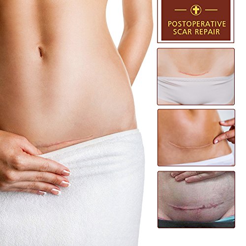 2 Pack Scar Removal Gel, Acne Mark Removal Cream Ointment, Soften...