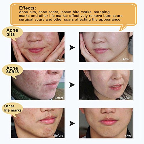 2 Pack Scar Removal Gel, Acne Mark Removal Cream Ointment, Soften...