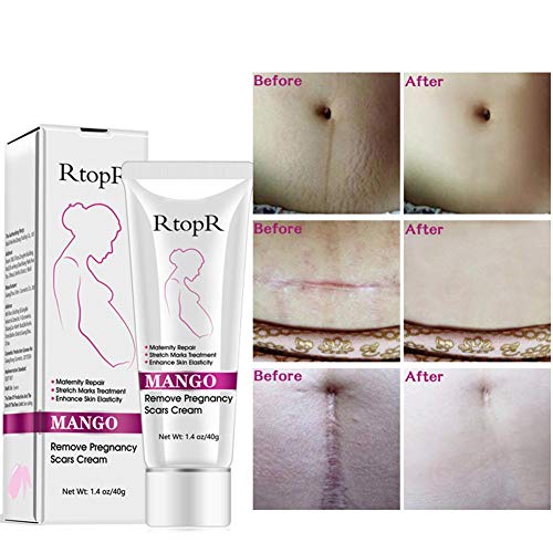 Rosymity Mango Anti-Stretch Mark Cream,with Reduces Stretch Marks...