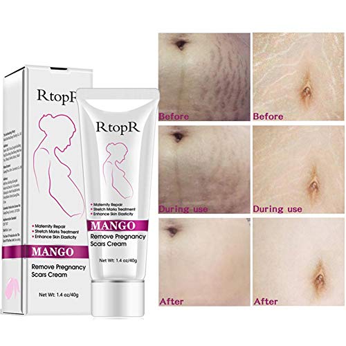 Rosymity Mango Anti-Stretch Mark Cream,with Reduces Stretch Marks...