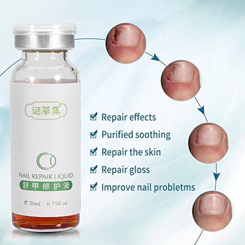 SoarUp Nail Fungus Treatment, Anti Fungus Nail Treatment Onychomy...