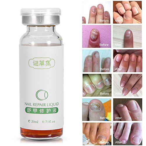 SoarUp Nail Fungus Treatment, Anti Fungus Nail Treatment Onychomy...