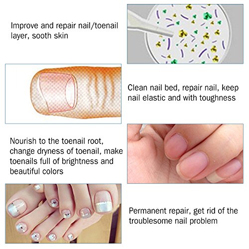 SoarUp Nail Fungus Treatment, Anti Fungus Nail Treatment Onychomy...