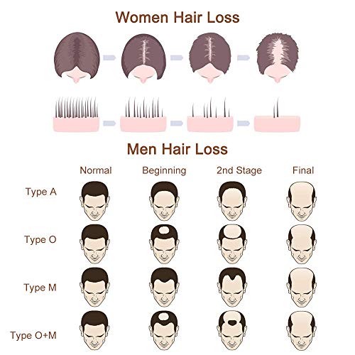 Hair Grow Spray, Anti Hair Loss, Thinning, Balding, Natural Ingre...