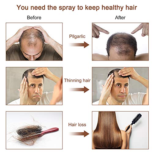 Hair Grow Spray, Anti Hair Loss, Thinning, Balding, Natural Ingre...