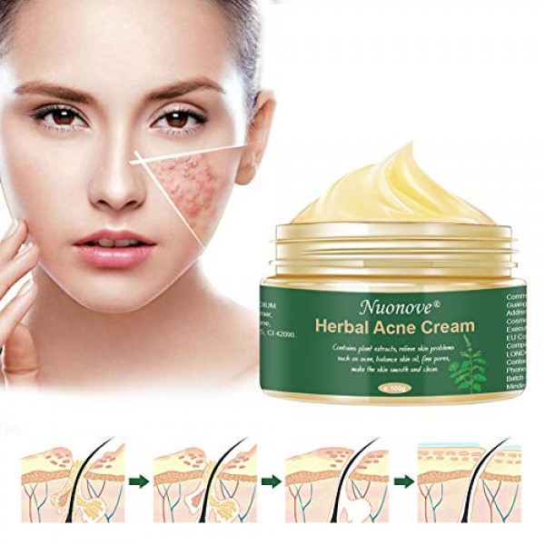 Acne Scar Remover Cream, Acne Treatment Cream, Acne Scar Cream, A...