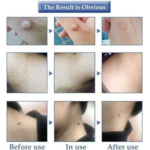 Organic Tags Solutions Serum Mole & Skin Tag Removal Solution Pai...