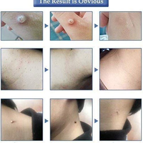 Organic Tags Solutions Serum Mole & Skin Tag Removal Solution Pai...