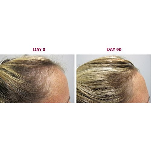 180 3 month supply hair growth tablets ...