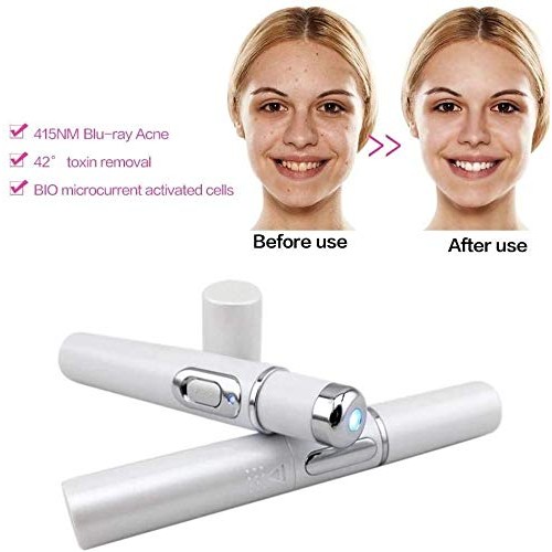Blue Light Pen for Spider Veins,Blue-Light Acne Remove,Blue Light...