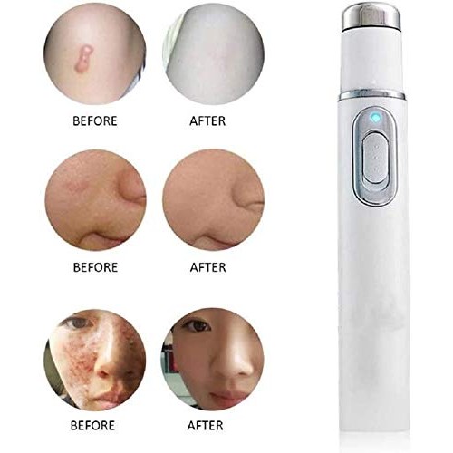 Blue Light Pen for Spider Veins,Blue-Light Acne Remove,Blue Light...