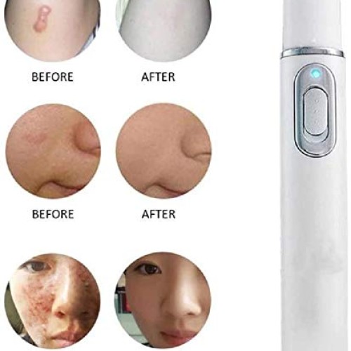 Blue Light Pen for Spider Veins,Blue-Light Acne Remove,Blue Light...