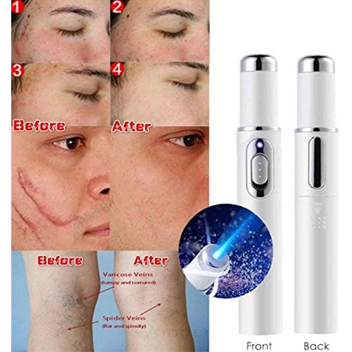 Blue Light Pen for Spider Veins,Blue-Light Acne Remove,Blue Light...