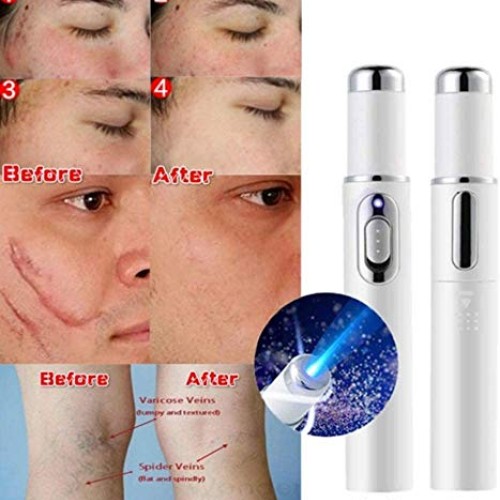 Blue Light Pen for Spider Veins,Blue-Light Acne Remove,Blue Light...
