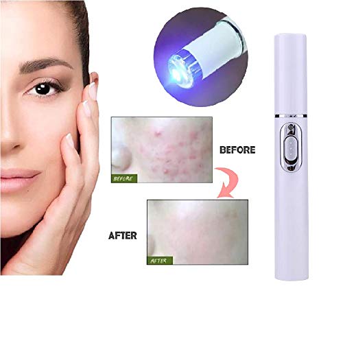 Blue Light Pen for Spider Veins,Blue-Light Acne Remove,Blue Light...