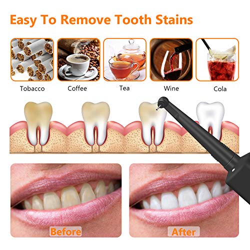 Electric Dental Calculus Remover Tooth Tartar Cleaning Teeth Tool...